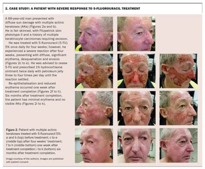 Should i stop using topical steroids?