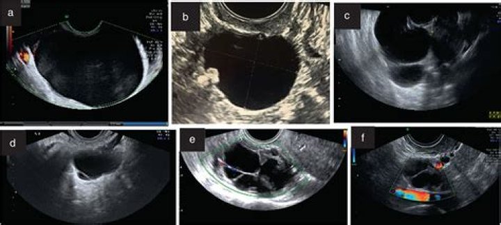 Should ovarian teratoma be removed?