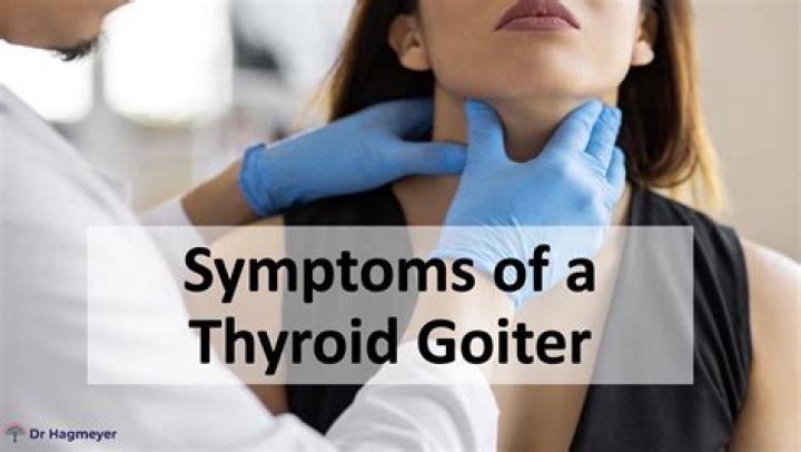 Should thyroid goiters be removed?