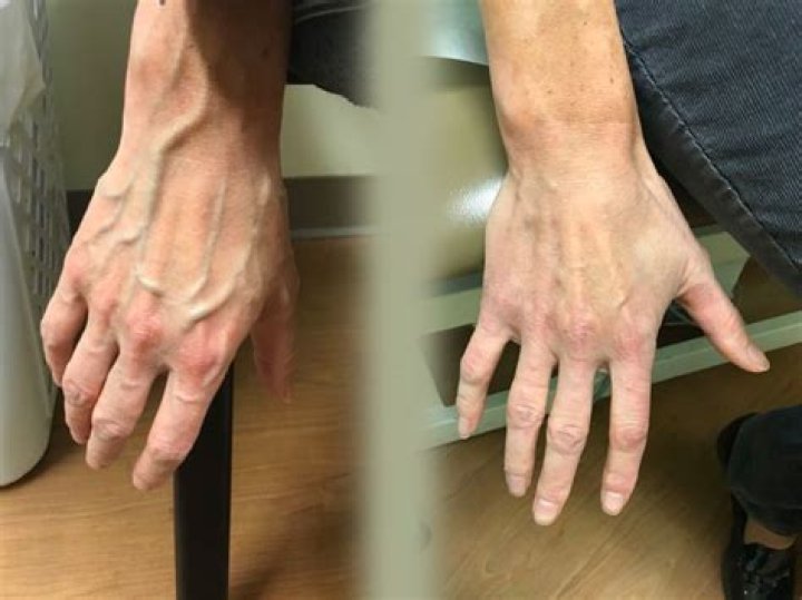 Should veins be visible?