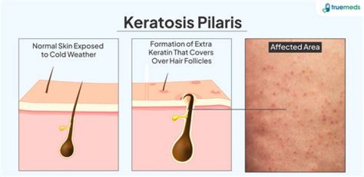 Should you moisturise keratosis pilaris?