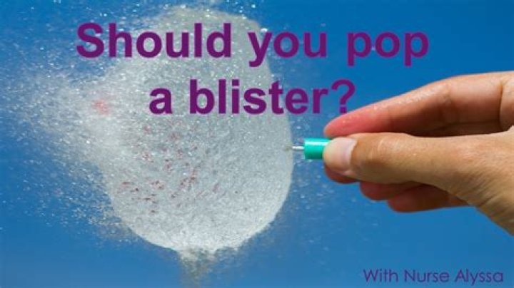 Should you pop blisters caused by sunburn?