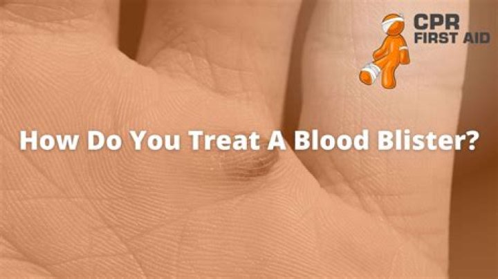 Should you prick a blood blister?