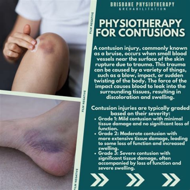 Should you put heat on a contusion?
