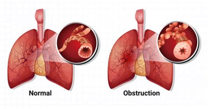 Was does obstruction mean?