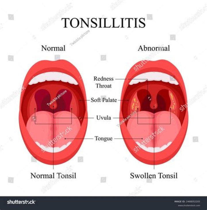 Was i born without tonsils?