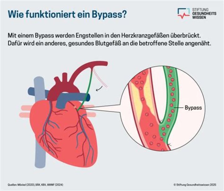 Was ist ein bypass?