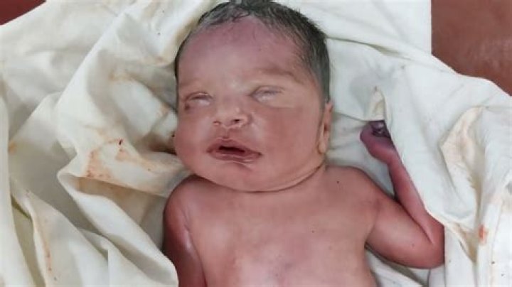 Was lindbergh baby deformed?