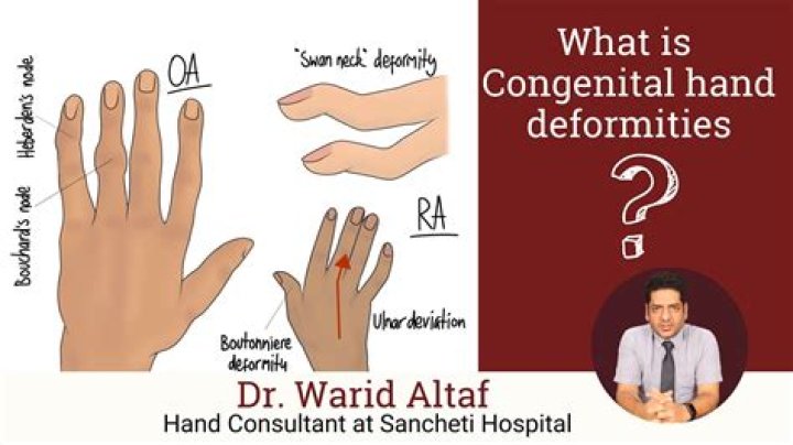 Was radars hand deformed?