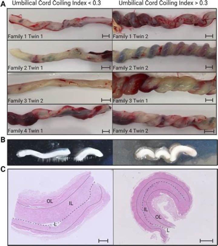 Was the umbilical cord?