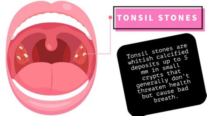 Were do tonsil stones come from?
