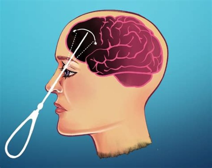 Were lobotomies done with anesthesia?