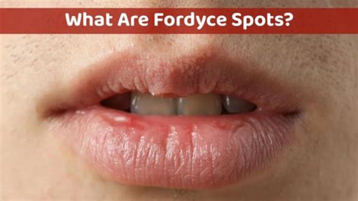 What are fordyce spots on shaft?