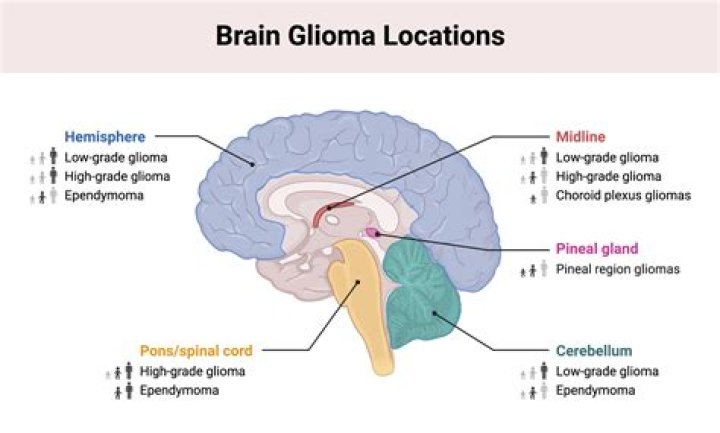 What are the grades of gliomas?