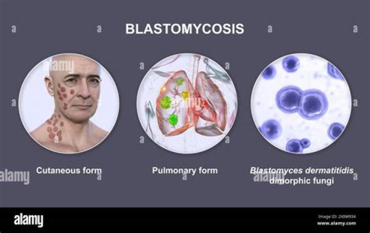 What are the symptoms of blastomycosis in humans?