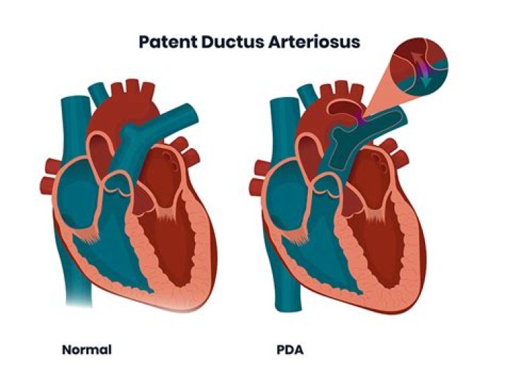 What are the symptoms of patent ductus arteriosus?