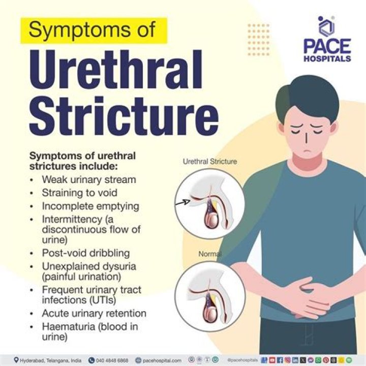 What are the symptoms of urethral stricture?
