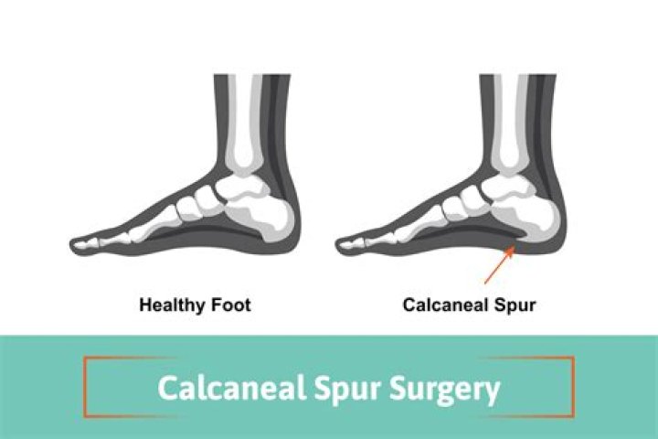 What calcaneal spur means?