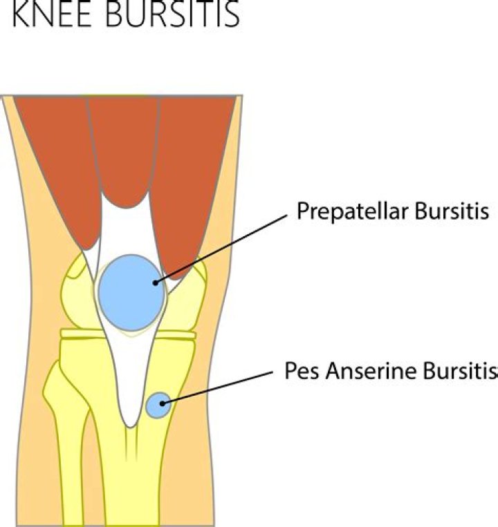What causes anserine bursitis?
