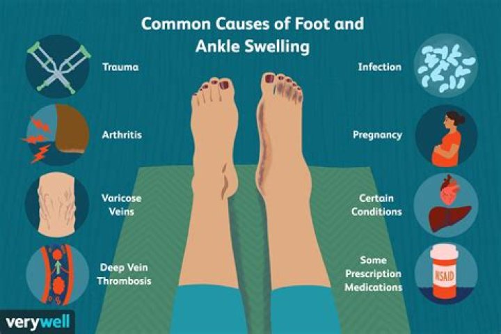 What causes instep swelling?