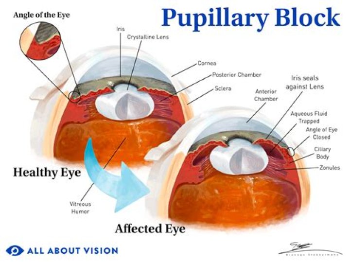 What causes pupillary athetosis?