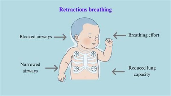 What causes retractions in newborns?