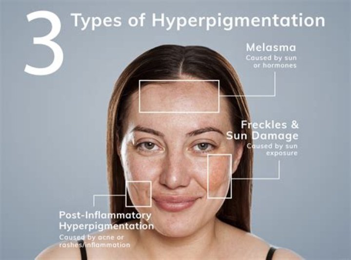 What causes skin pigmentation?