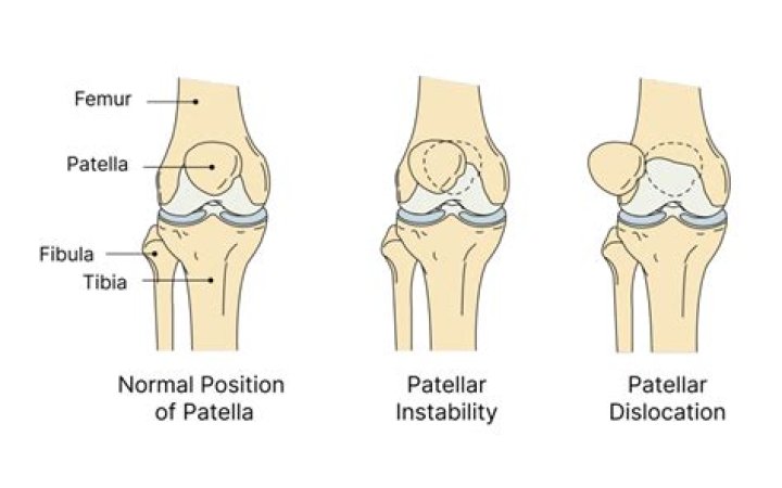 What causes subluxated patella?