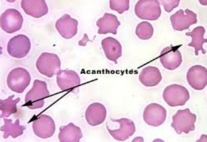 What do acanthocytes indicate?