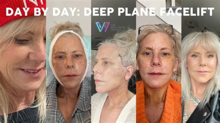 What do facelifts cost?
