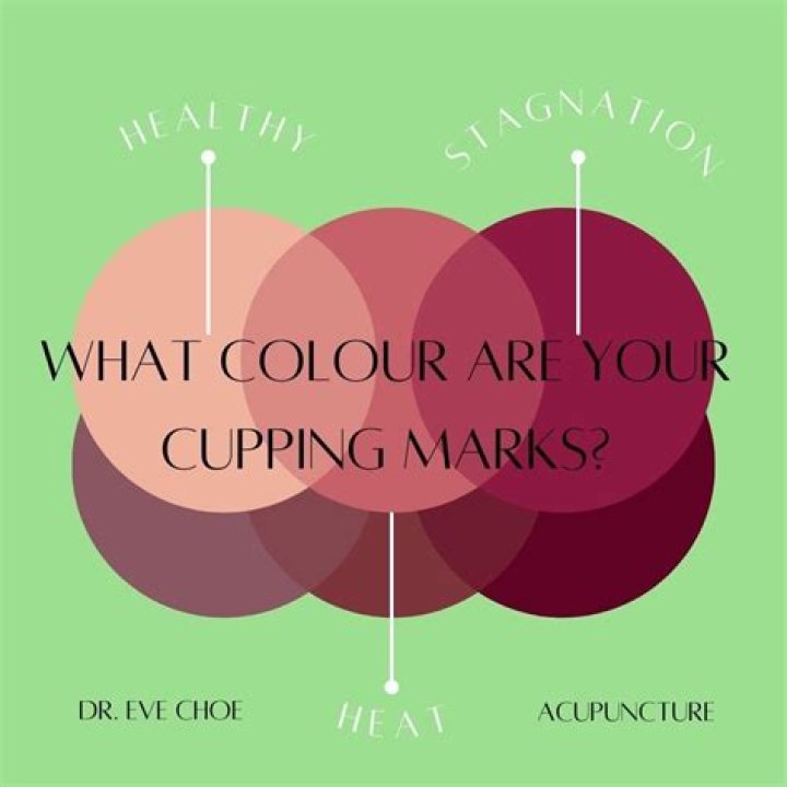 What do the cupping marks mean?