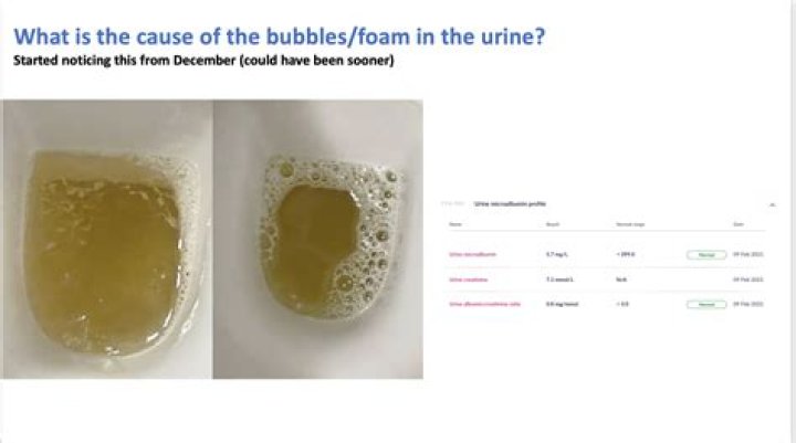 What does a little foam in urine mean?