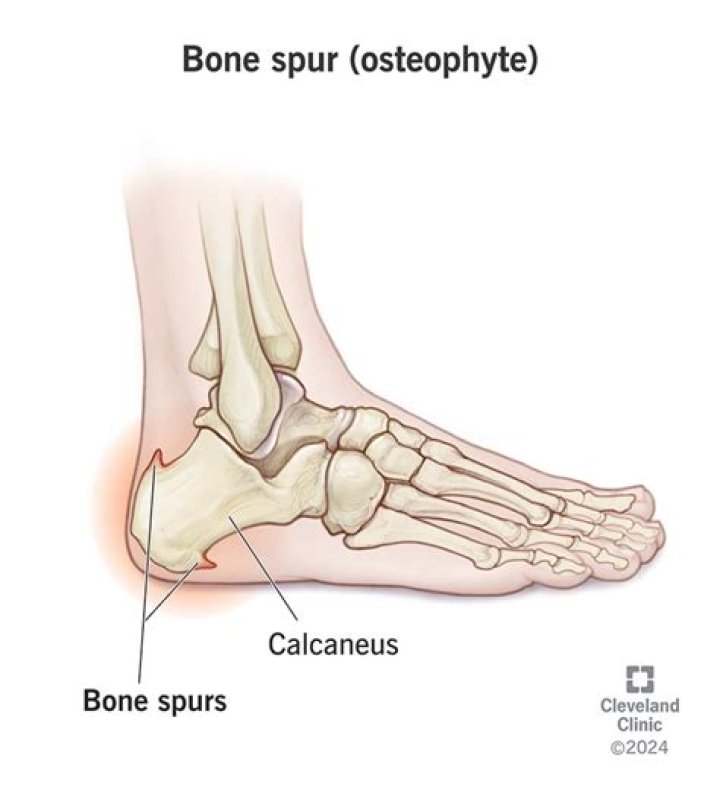 What does a spur-galled mean?