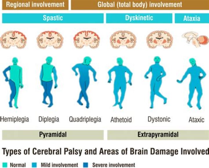 What does athetoid cerebral palsy mean?