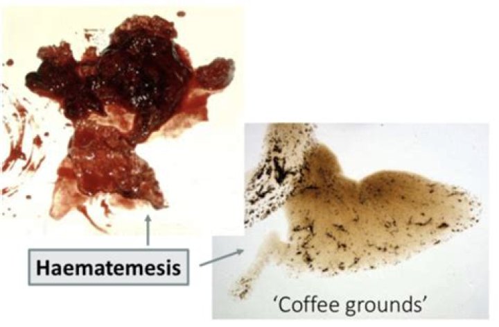 What does coffee ground vomitus mean?