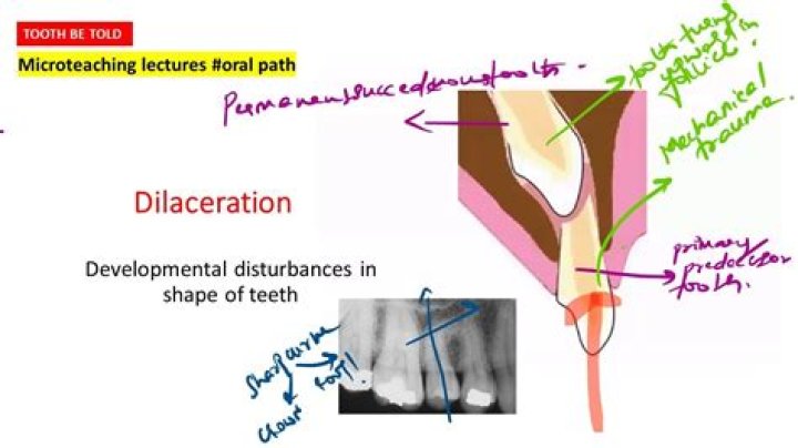 What does dilaceration mean?