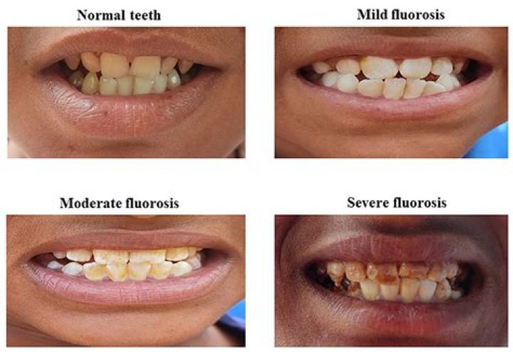 What does fluorosis do?
