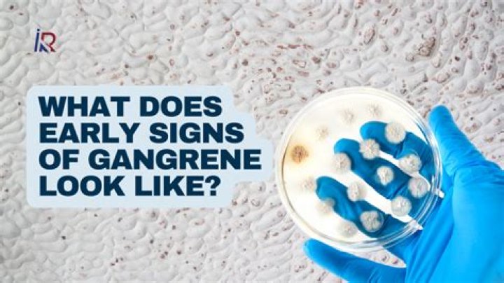 What does fournier's gangrene look like?