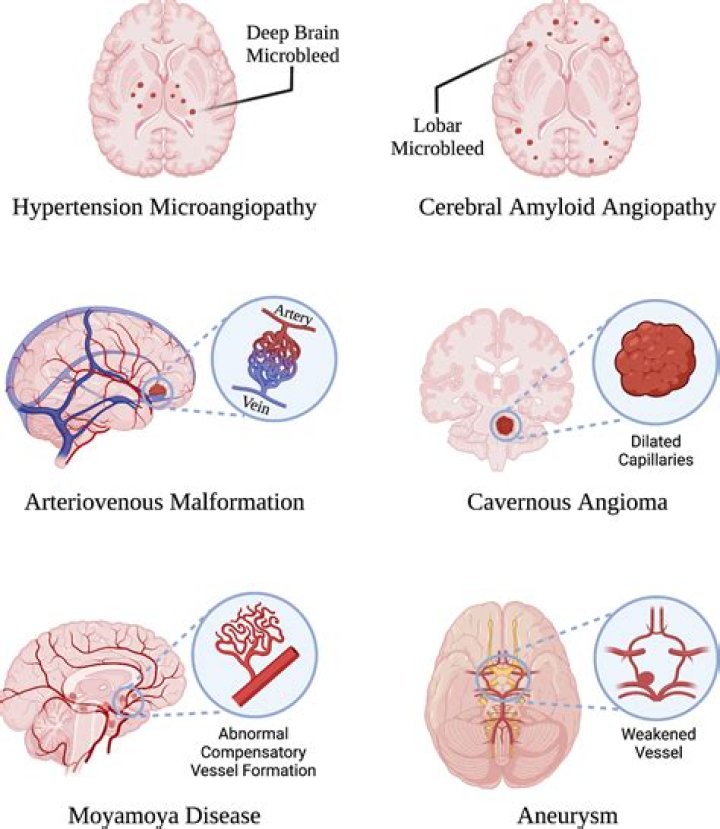 What does intracerebral mean in medical terms?