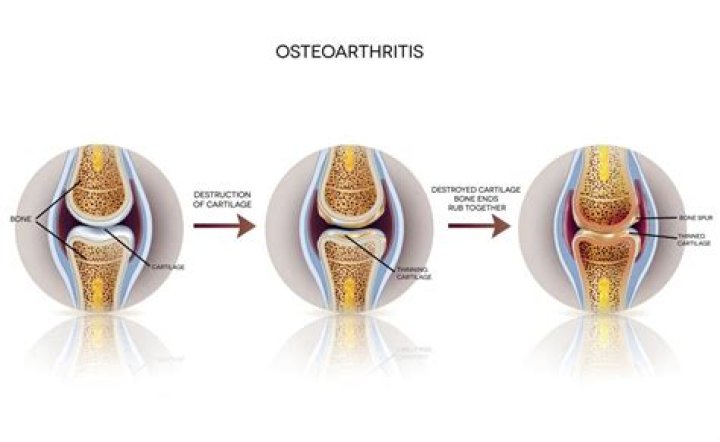 What does osteoarthritic changes mean?