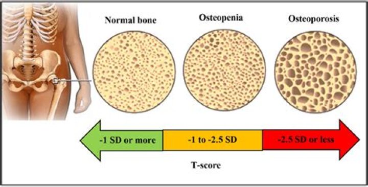 What does osteomalacia mean in medical terms?