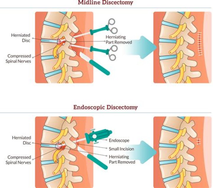 What does osteotomies mean?