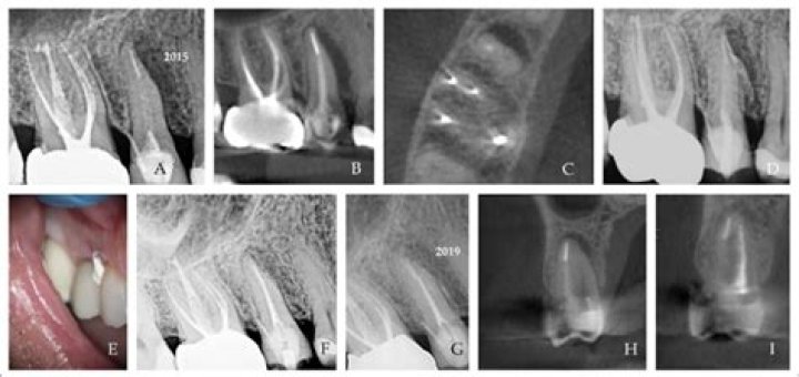 What does parl mean in dentistry?