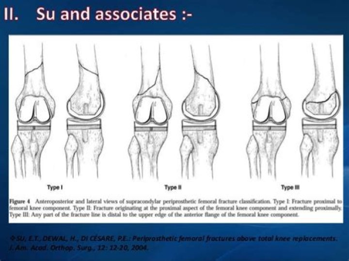 What does periprosthetic mean?