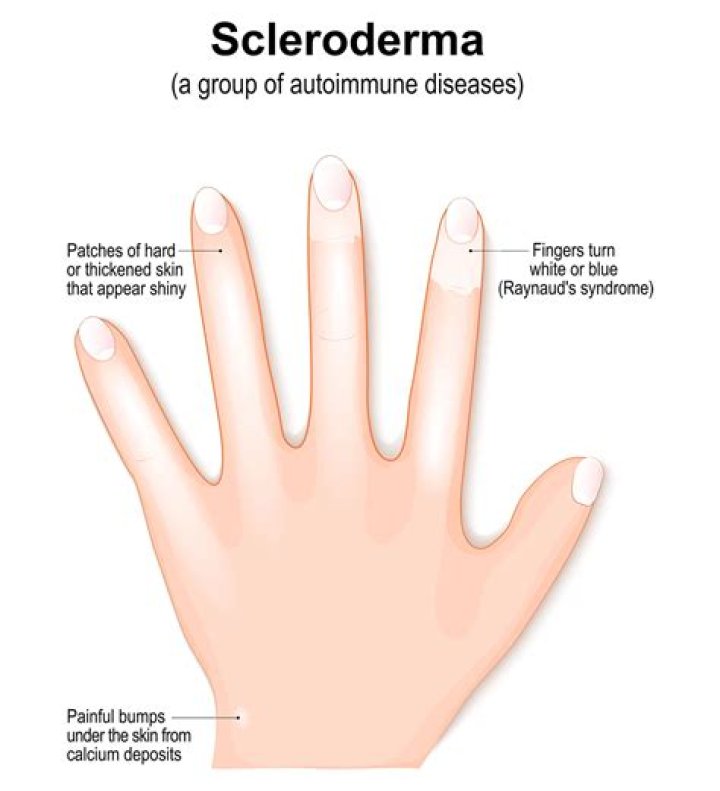 What does sclerodactyly mean?
