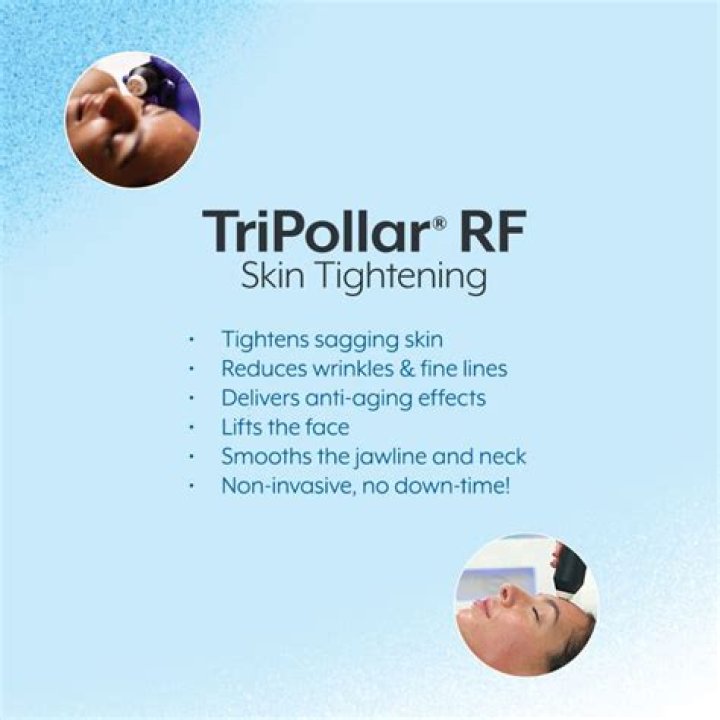 What does tripolar rf do?