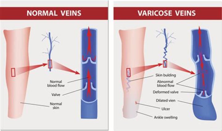 What does venous blood mean?