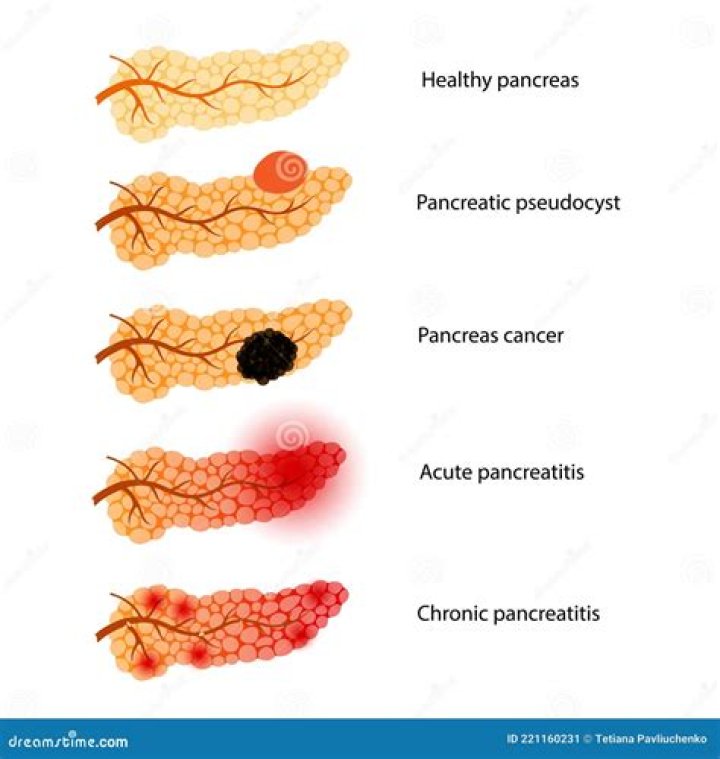 What haemorrhagic necrotising pancreatitis?