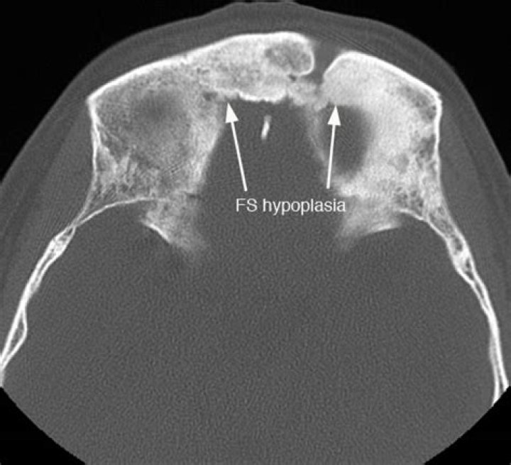 What hypoplastic frontal sinus?