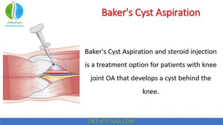 What is a bakers cyst and treatment?